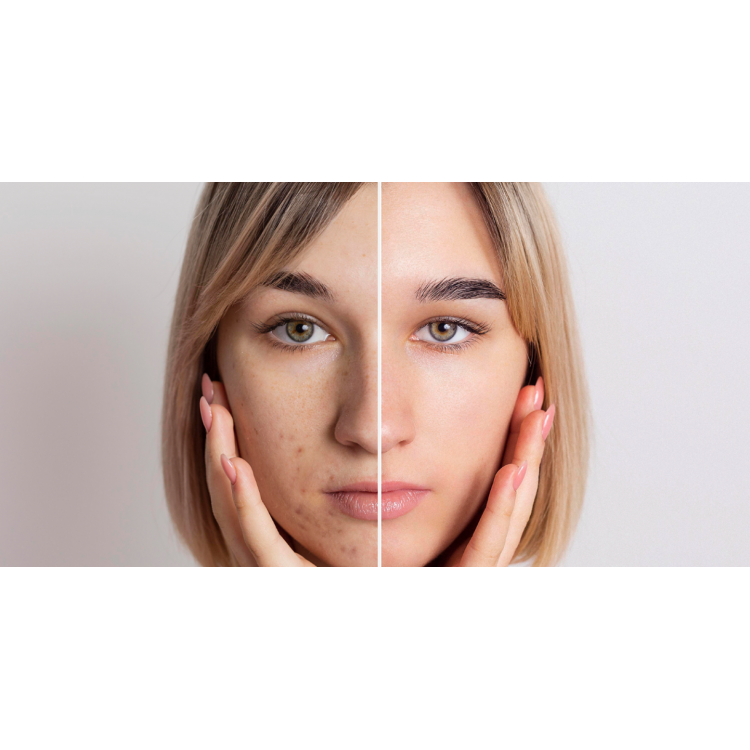 Розширені пори: проблема чи норма?